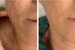1, 2, or 3 IPL Photo Facials at Laser Options by Jen LLC for Redness, Pigmentation & Fine Lines (Up to 60% Off) - Second Medium