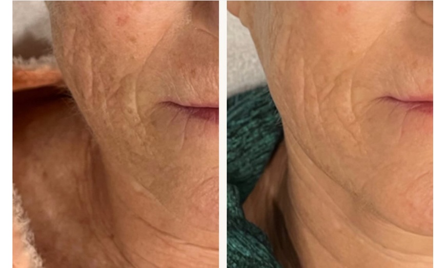 Image 4: 1, 2, or 3 IPL Photo Facials to Target Redness, Pigmentation & Texture