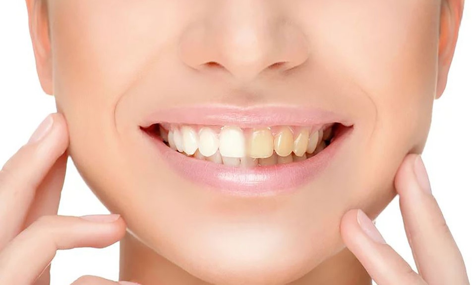 30 Min. kosmetisches Zahn-Bleaching inkl. Beratung für 1 Person