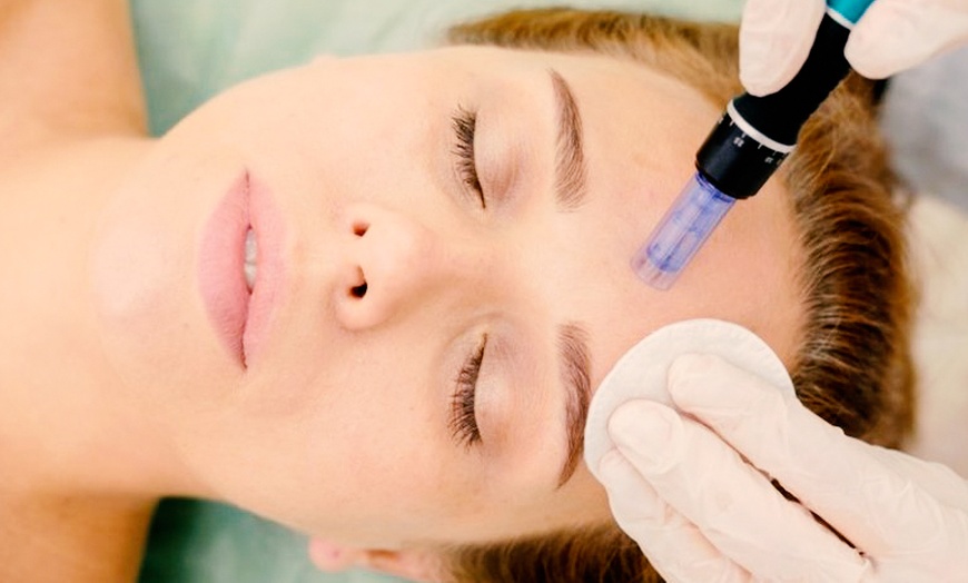 Image 9: 1, 2 o 3 sesiones de microlifting facial de vitaminas con Dermapen