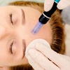Image 9: 1, 2 o 3 sesiones de microlifting facial de vitaminas con Dermapen