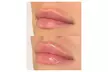 One Syringe of Juvederm Ultra or Juvederm Ultra Plus at Spa Bella Medispa (Up to 43% Off) - Second Medium