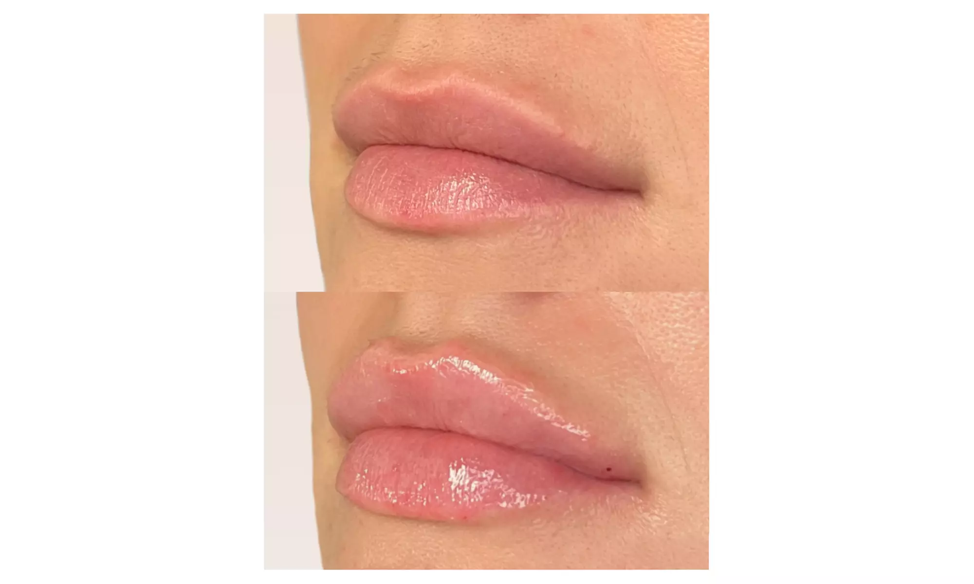 Up to 49% Off on Injection - Dermal Filler at Spa Bella Medispa