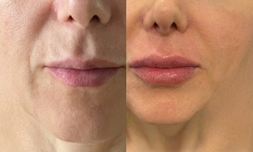 Image 2: Enhance Your Skin with 20 Units of Letybo with Lip Flip