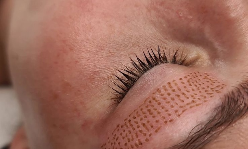 Image 5: Achieve Firmer, Younger-Looking Skin with Fibroblast Treatment