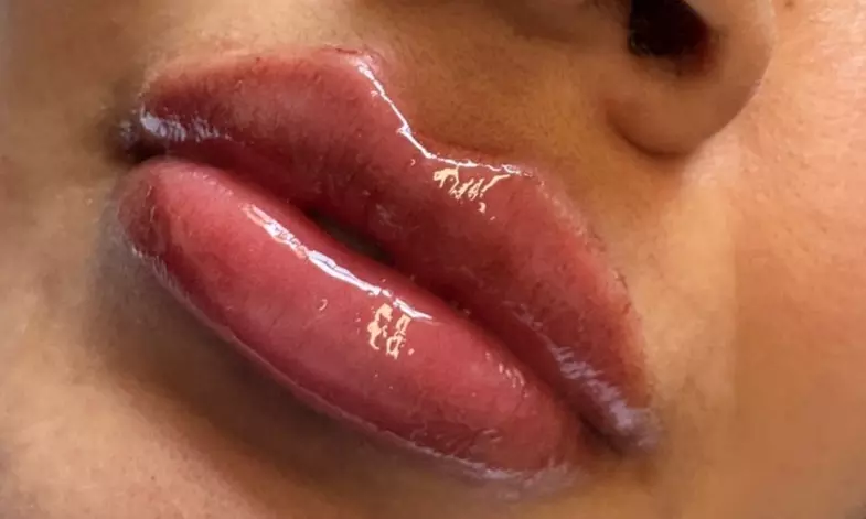 Get One Russian Lips, Classic Lips, Rhinoplasty or Tear Trough