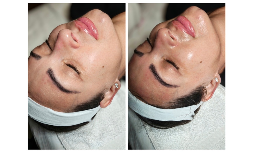 Image 6: Microdermabrasion or Microchanneling Facial for Rejuvenated Skin