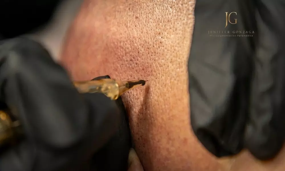 2 sesiones de micropigmentación capilar con técnica FUT o FUE