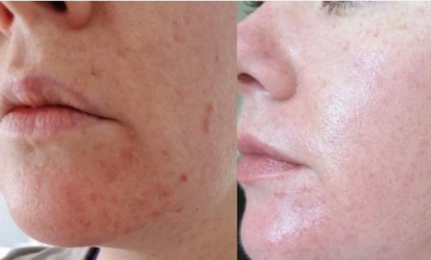 Image 3: Reveal Glowing Skin with One or Two Chemical Peels Session