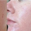 Image 3: Reveal Glowing Skin with One or Two Chemical Peels Session