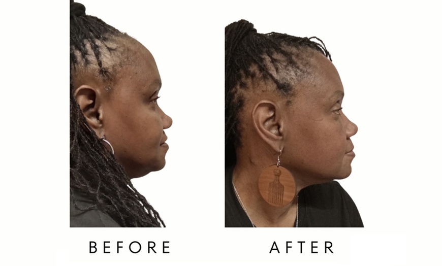 Image 2: Chin Sculpt Max – Non-Invasive Chin Fat Reduction & Contouring in DC