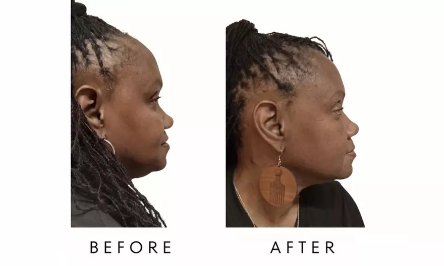 FACE-TITE - Face/Neck Tightening & Contour Lift at Your Sculpt Studio