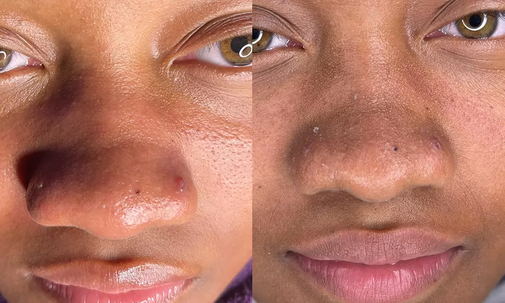 One, Three, or Five Sessions of Advanced HydraFacial or DermaPlaning