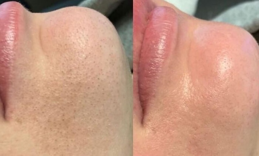 Image 5: Up to 63% Off on Chemical Peel at Allure Passions Aesthetic Clinic