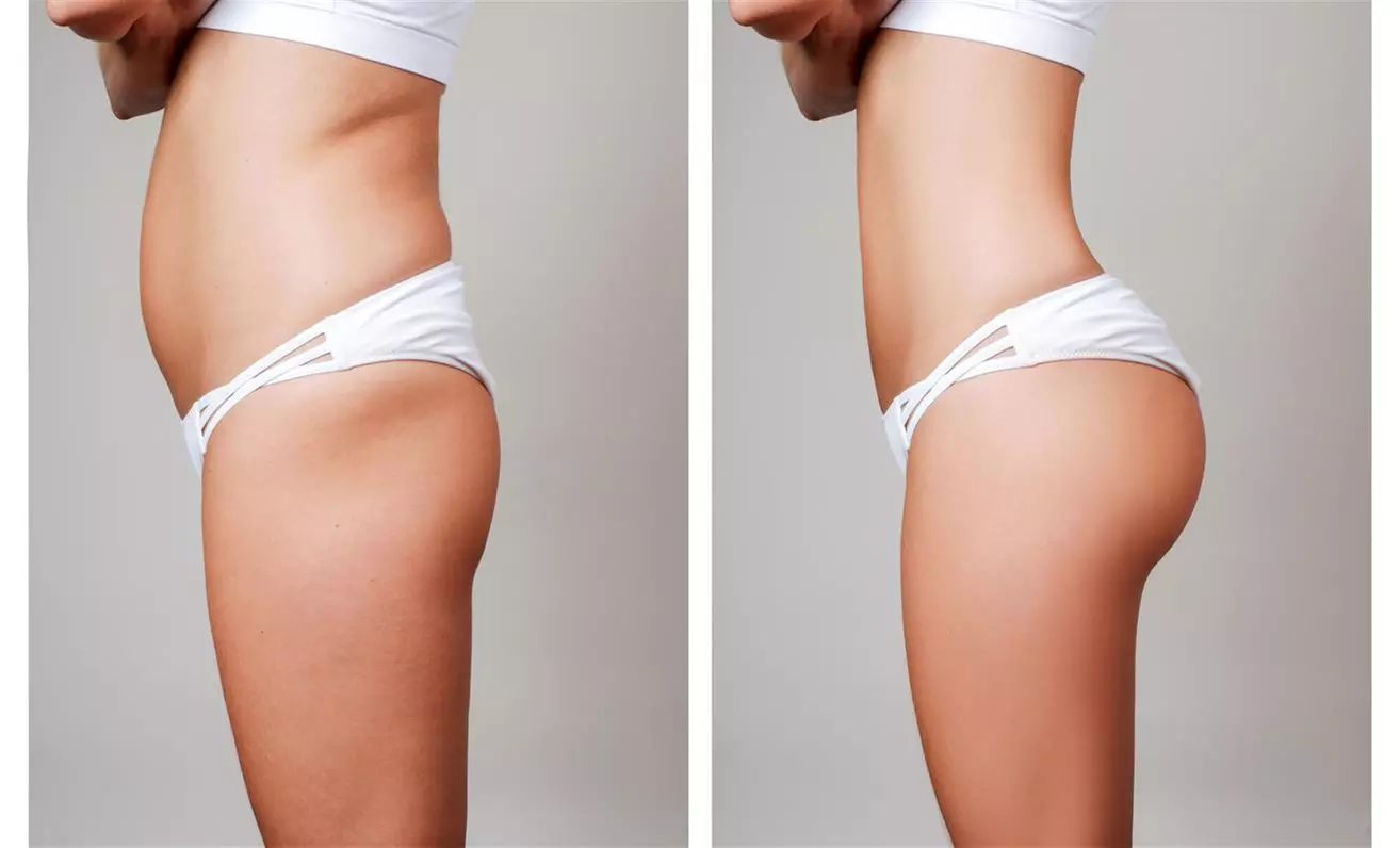 Experience up to 35% off at Beauty By Design with multiple non-surgical butt lift options for tailored enhancements.