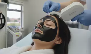 59% Off Carbon Laser Facial for a Radiant, Clear Complexion