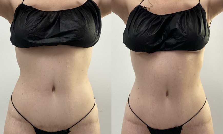 Image 4: Up to 45% Off for Post-op Lymphatic Massage at Cali Bods 
