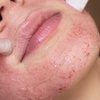 Image 1: Enhance Skin Texture with Micro-Needling Options