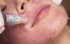 Explore micro-needling options at iBeauty PMU and Lashes, including treatments with hyaluronic acid, up to 36% off