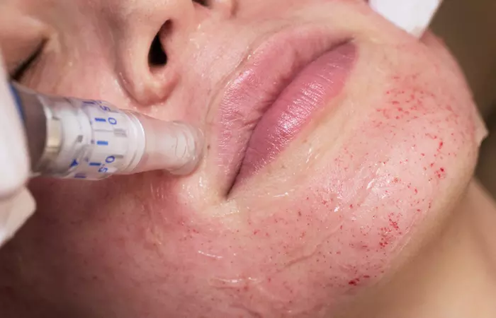 Explore micro-needling options at iBeauty PMU and Lashes, including treatments with hyaluronic acid, up to 36% off - Primary Image