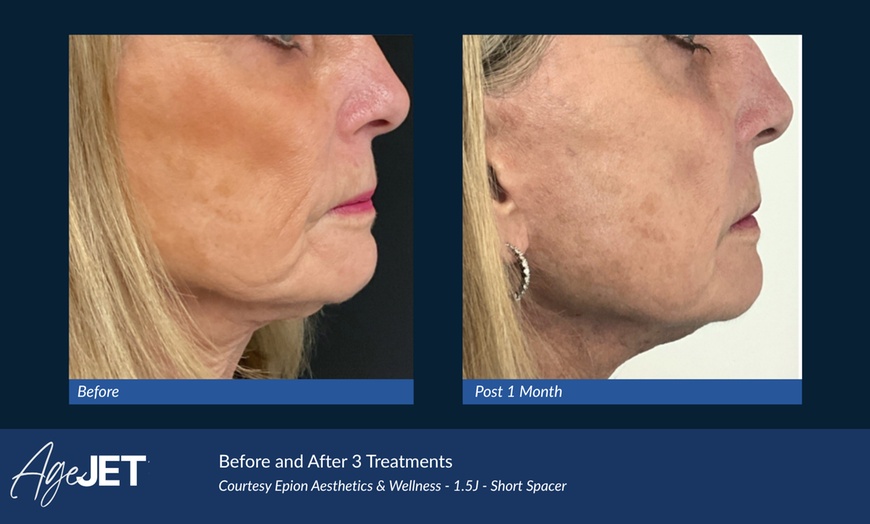 Image 8: CO2 Laser Skin Resurfacing Treatment with Optional Peptide 