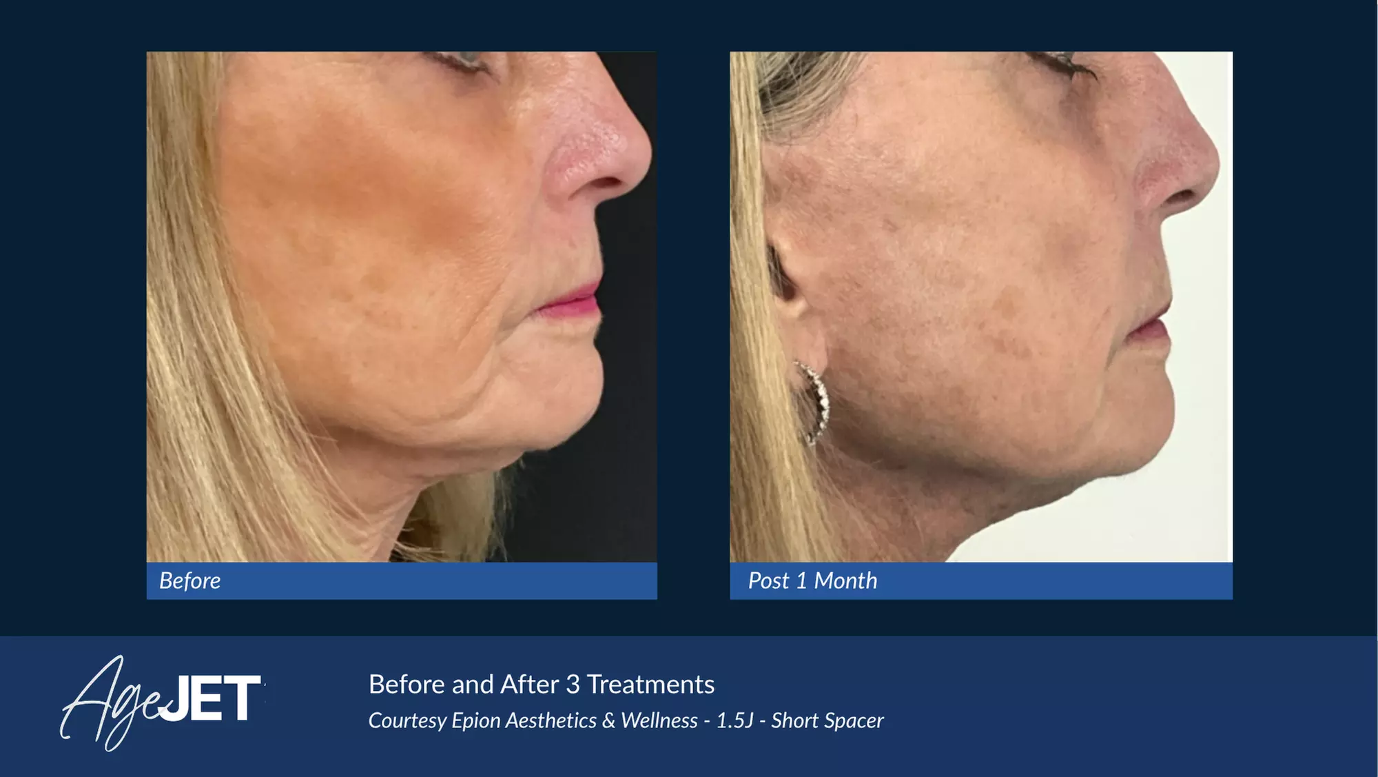 CO2 Laser Skin Resurfacing Treatment with Optional Peptide