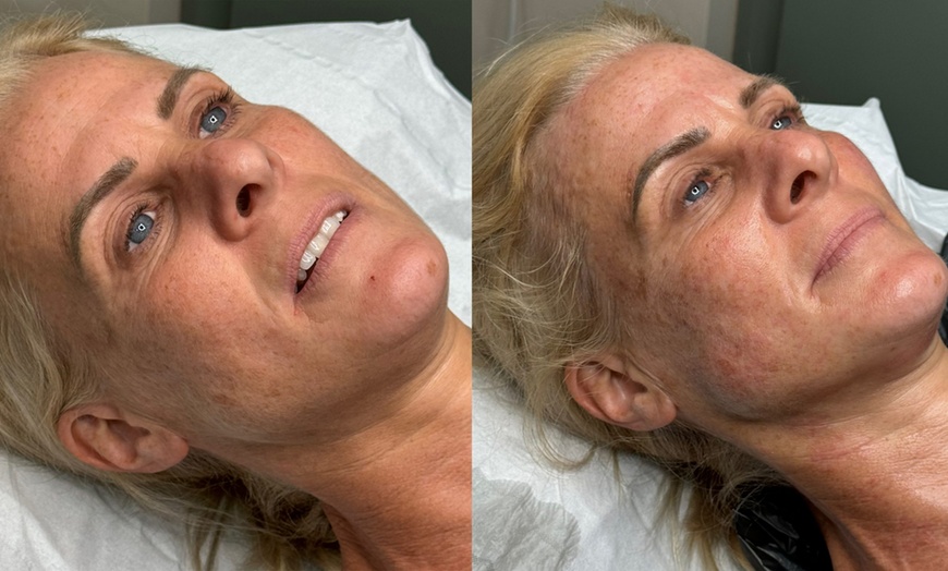 Image 5: Revitalize Skin w/ HIFU Face with Optional Body Area or Neck Treatment