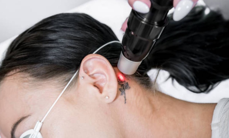Image 10: 5 o 10 sesiones de eliminación de tatuajes