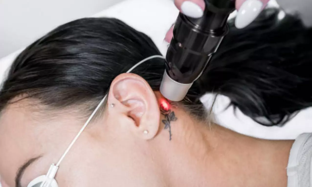 5 o 10 sesiones de eliminación de tatuajes