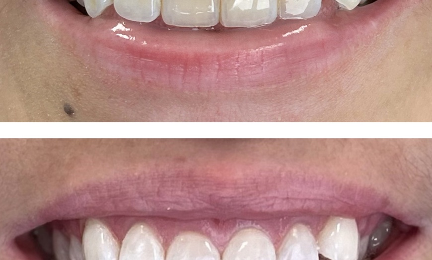 Image 3: Get a Brighter Smile with Phillips Zoom Whitening! Teeth Whitening