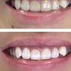 Image 3: Get a Brighter Smile with Phillips Zoom Whitening! Teeth Whitening