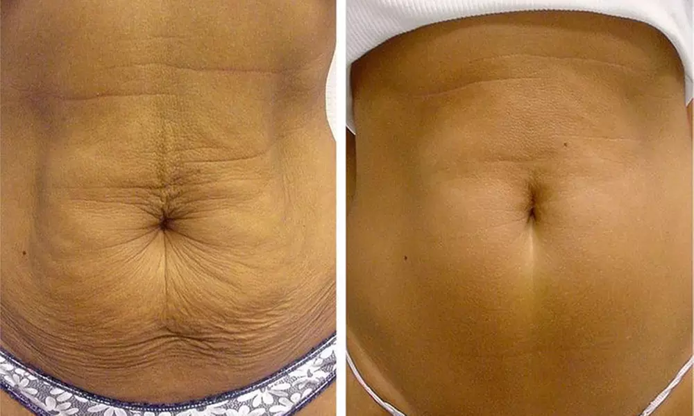 Three or Six RF Skin Tightening Sessions at A.SimoneAesthetics - Up to 50% Off - Primary Image