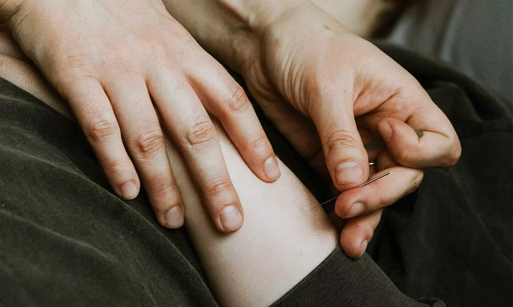 3 60 or 70-Minute Community Acupuncture with Optional  Fire Cupping