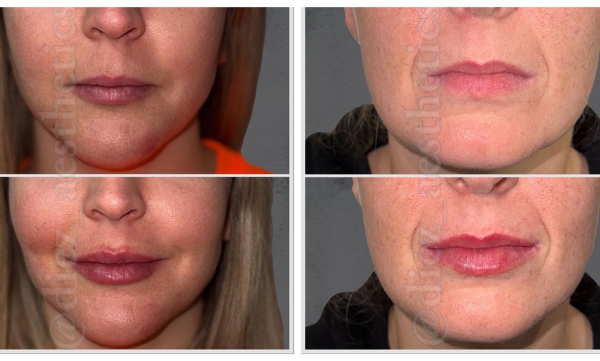 Image 1: Clinical Dermal Filler for Beautifully Enhanced Lips - 0.5 or 1ml