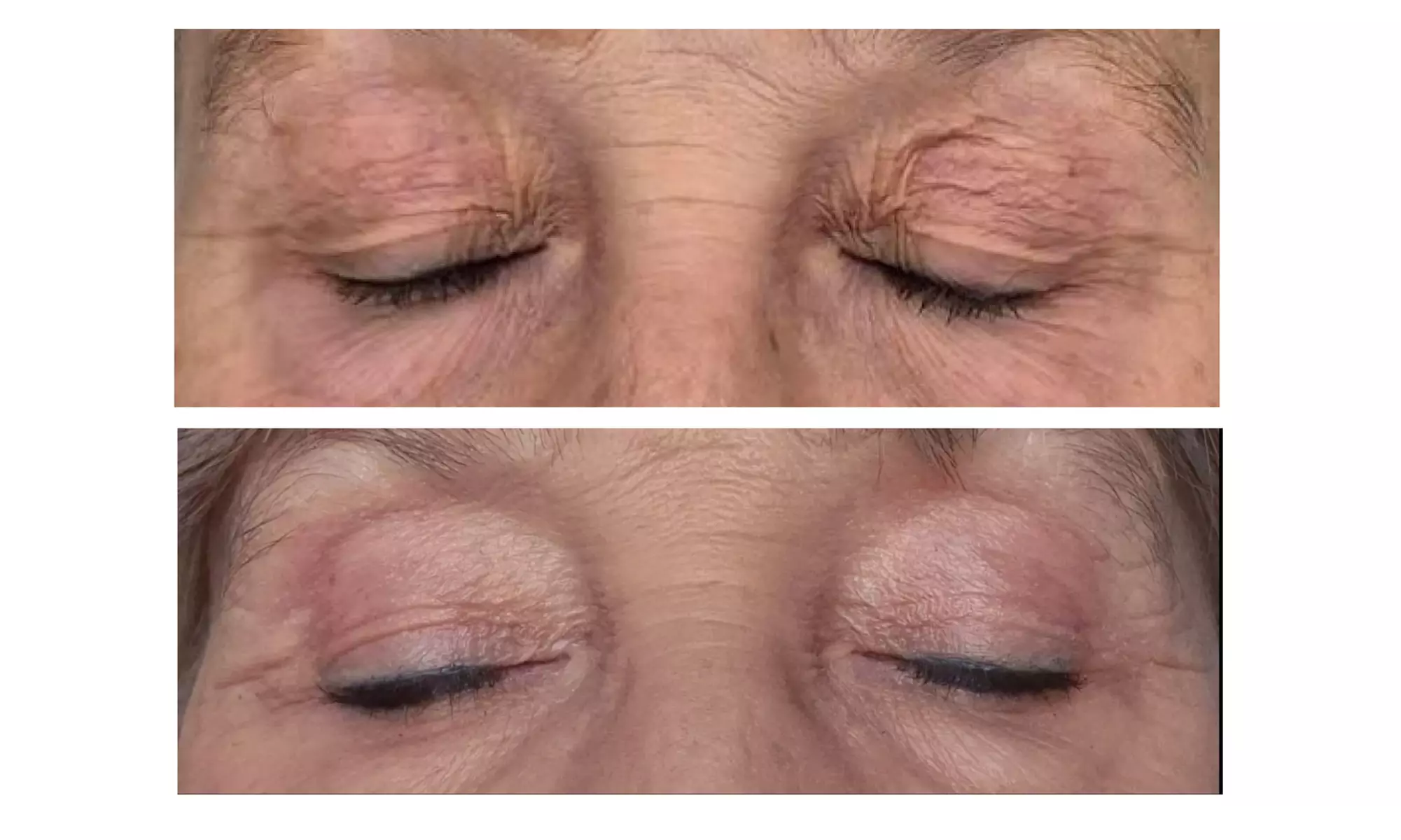 Plasmalift: Oberlidstraffung & Lifting mit Skin Corrector für 1 Person