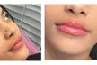 Get 1ML or 2ML Hyaluronic Acid Needle-less Lip Enhancements or Injection at Boho beauty and spa (Up to 30% Off) - Second Medium
