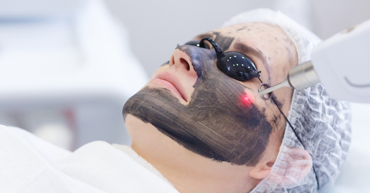 Tratamiento facial Hollywood peeling con carbón activo y láser en Alicante