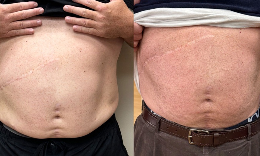 Image 4: Glow, Lift, And Renew With Laser Genesis, RF, PRP, And Tone Sessions