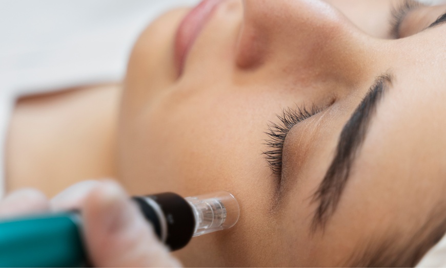 Image 1: Sesión de microneedling de labios o facial con activos hidratantes 
