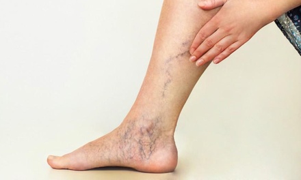6 Spider Veins  or 6 Broken Capillary Treatments - New Face Cosmetic Clinic
