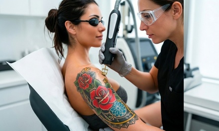 1 session of Perigee QS Laser - Laser Tattoo Removal Colored Ink up to 5 Square Inches - Lux Veritae Skin Spa