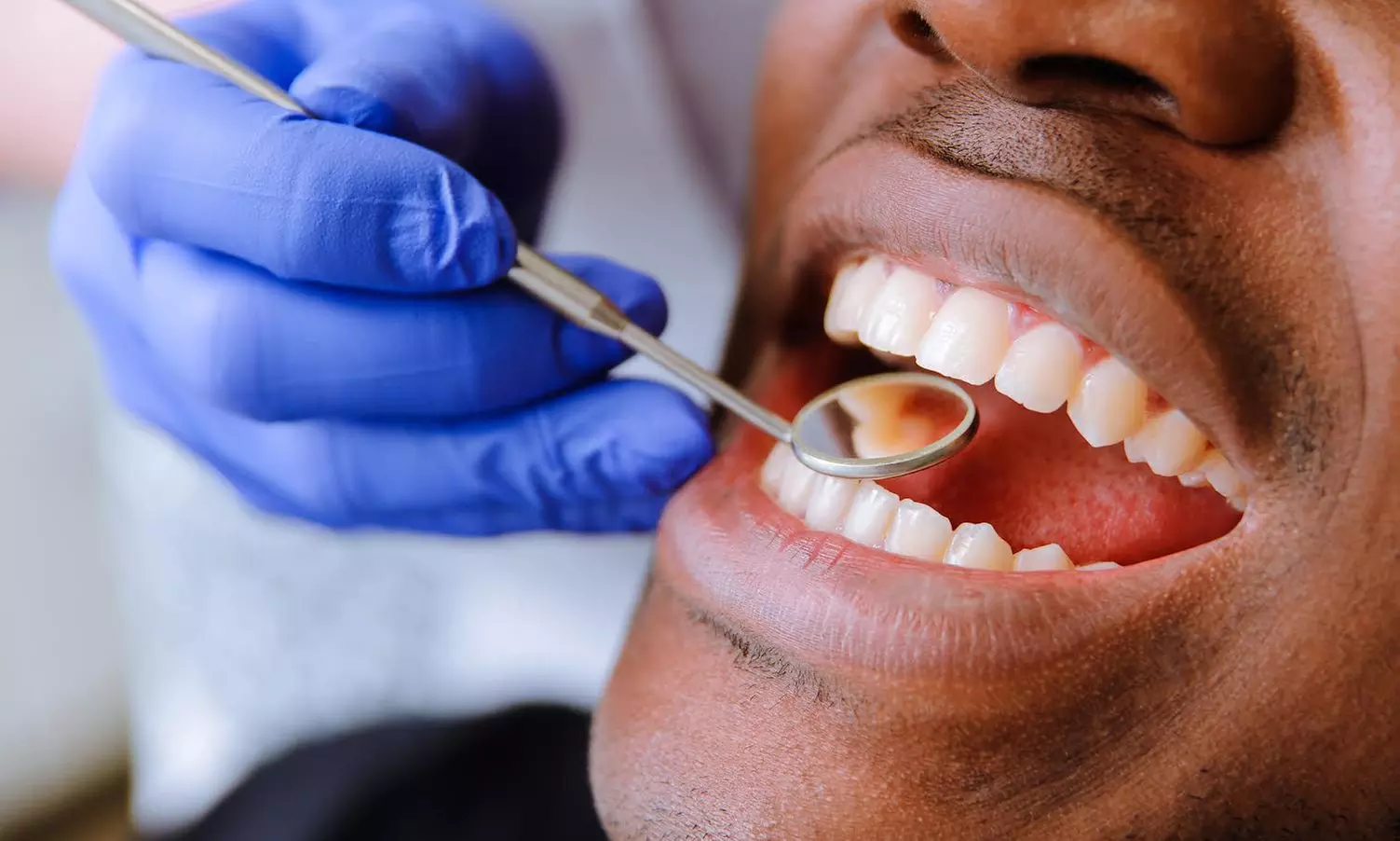 Airflow Teeth Cleaning or Scale and Polish with Dental Consultation