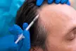 PRP & PRF EZ Gel Injections for Face, Under-Eyes & Hair at Jeniva Ny Aesthetics And Wellness - Up to 55% Off - Second Medium
