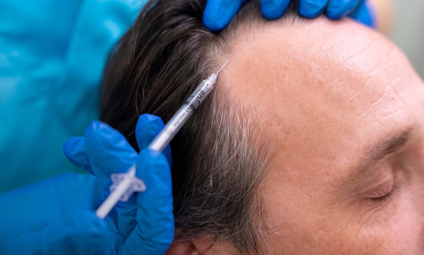 Image 3: PRP & PRF EZ Gel Injections for Face, Under-Eyes & Hair Restoration