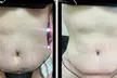 Discover specialized Post-op care ( after lipo/ bbl/ tummy tucks) service at Nenas Beauty Glow Bar - Second Medium