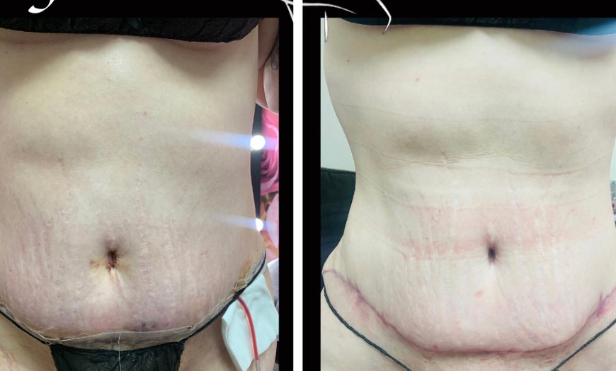 Image 2: Embrace a comprehensive Post-op care (after lipo/ bbl/ tummy tucks)