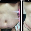 Image 2: Embrace a comprehensive Post-op care (after lipo/ bbl/ tummy tucks)