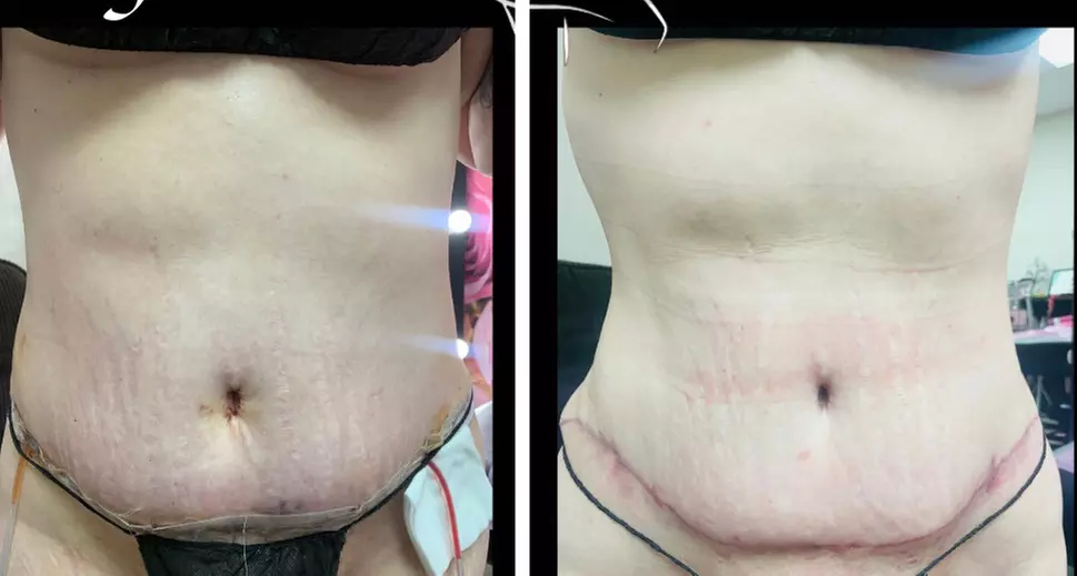 Embrace a comprehensive Post-op care (after lipo/ bbl/ tummy tucks)
