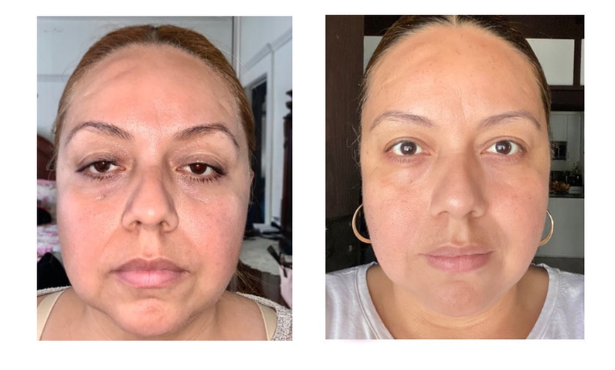Image 4: Turn Back The Clock on Your Skin with 20, 40 or 60 Units of Xeomin