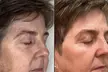 One/Three/Five TriLift w/ Deep Muscle Stimulation, RF & Microneedling (Up to 59% Off) - Second Medium